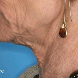 Fractional CO2 Laser Before & After Patient #2309
