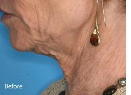 Fractional CO2 Laser Before & After Patient #2309