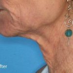 Fractional CO2 Laser Before & After Patient #2309