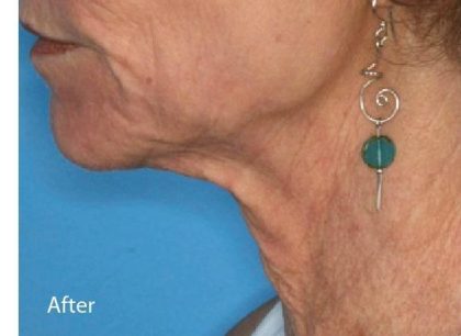 Fractional CO2 Laser Before & After Patient #2309