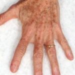 Fractional CO2 Laser Before & After Patient #2310