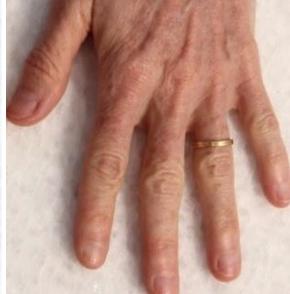 Fractional CO2 Laser Before & After Patient #2310