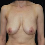 Breast Lift Before & After Patient #101
