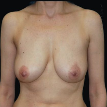 Breast Lift Before & After Patient #101