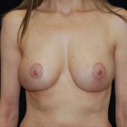 Breast Lift Before & After Patient #101