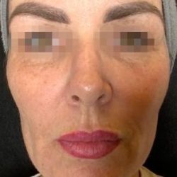 Fractional CO2 Laser Before & After Patient #2315