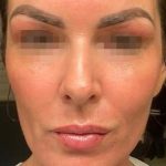 Fractional CO2 Laser Before & After Patient #2315