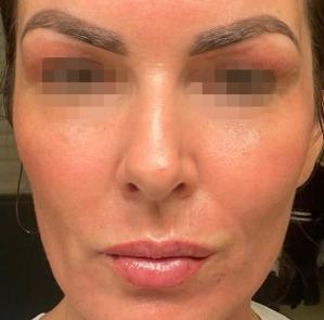 Fractional CO2 Laser Before & After Patient #2315