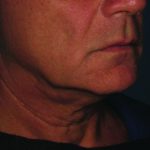 Ultherapy Before & After Patient #336