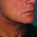 Ultherapy Before & After Patient #336