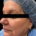 Morpheus8 Before & After Patient #413