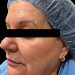 Morpheus8 Before & After Patient #413