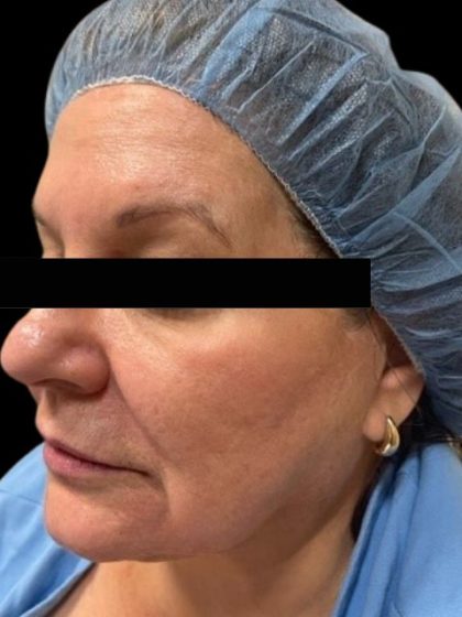 Morpheus8 Before & After Patient #413