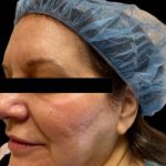 Morpheus8 Before & After Patient #413