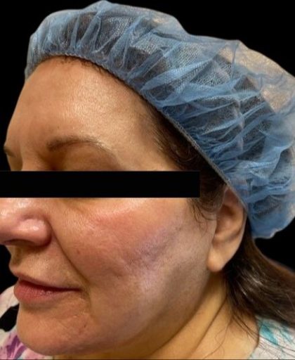 Morpheus8 Before & After Patient #413