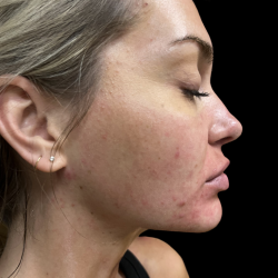 Morpheus8 Before & After Patient #419