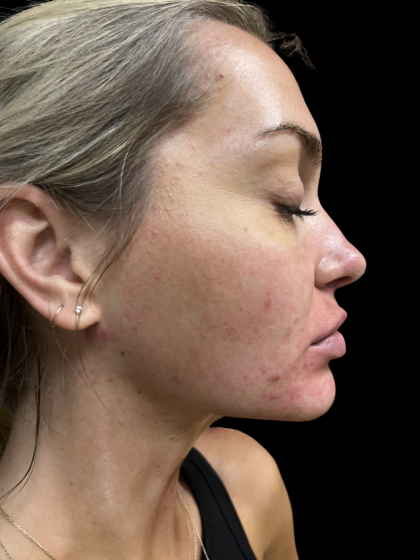 Morpheus8 Before & After Patient #419