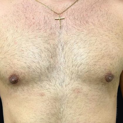 Gynecomastia Before & After Patient #2291