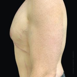 Gynecomastia Before & After Patient #2292
