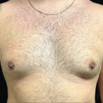 Gynecomastia Before & After Patient #2291
