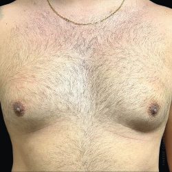 Gynecomastia Before & After Patient #2291