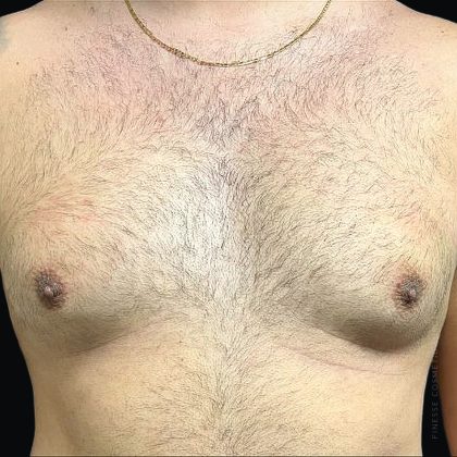 Gynecomastia Before & After Patient #2291