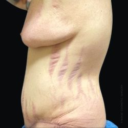 Gynecomastia Before & After Patient #2292