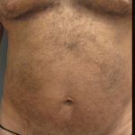 Gynecomastia Before & After Patient #2289