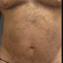 Gynecomastia Before & After Patient #2289