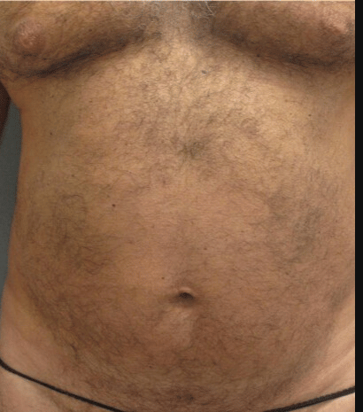 Gynecomastia Before & After Patient #2289