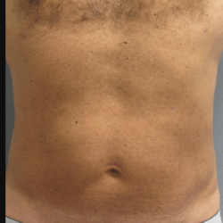 Gynecomastia Before & After Patient #2289
