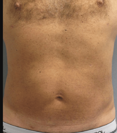 Gynecomastia Before & After Patient #2289