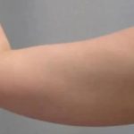 Smartlipo Vaser Lipo Before & After Patient #486
