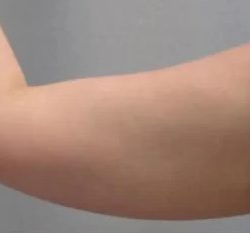 Smartlipo Vaser Lipo Before & After Patient #486