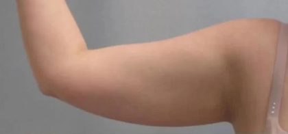 Smartlipo Vaser Lipo Before & After Patient #486