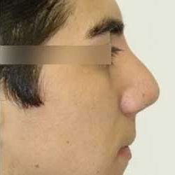 Rhinoplasty Before & After Patient #72