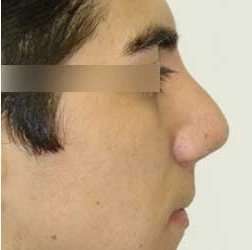 Rhinoplasty Before & After Patient #72