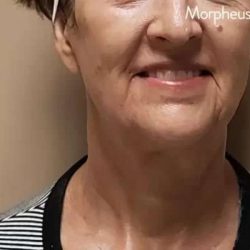 Morpheus8 Before & After Patient #401