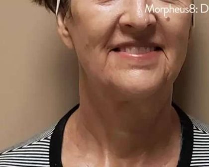 Morpheus8 Before & After Patient #401