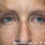 Morpheus8 Before & After Patient #404