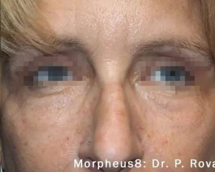 Morpheus8 Before & After Patient #404