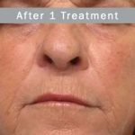 Morpheus8 Before & After Patient #407