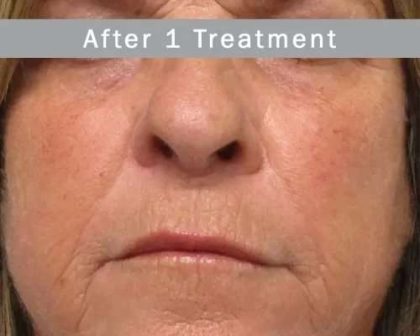Morpheus8 Before & After Patient #407