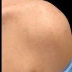 Morpheus8 Before & After Patient #422