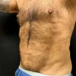 Smartlipo Vaser Lipo Before & After Patient #448