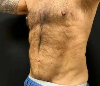 Smartlipo Vaser Lipo Before & After Patient #448