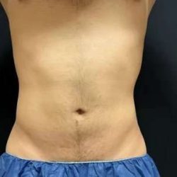 Smartlipo Vaser Lipo Before & After Patient #454