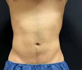 Smartlipo Vaser Lipo Before & After Patient #454