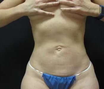 Smartlipo Vaser Lipo Before & After Patient #457