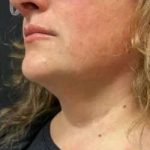 Smartlipo Vaser Lipo Before & After Patient #460